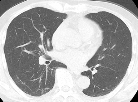健康診断の胸部CTで異常影を発見された無症状の62歳・男性